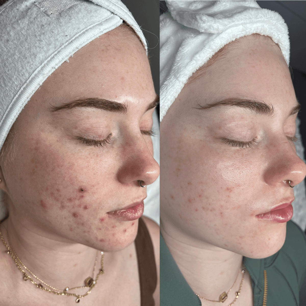 Before and After